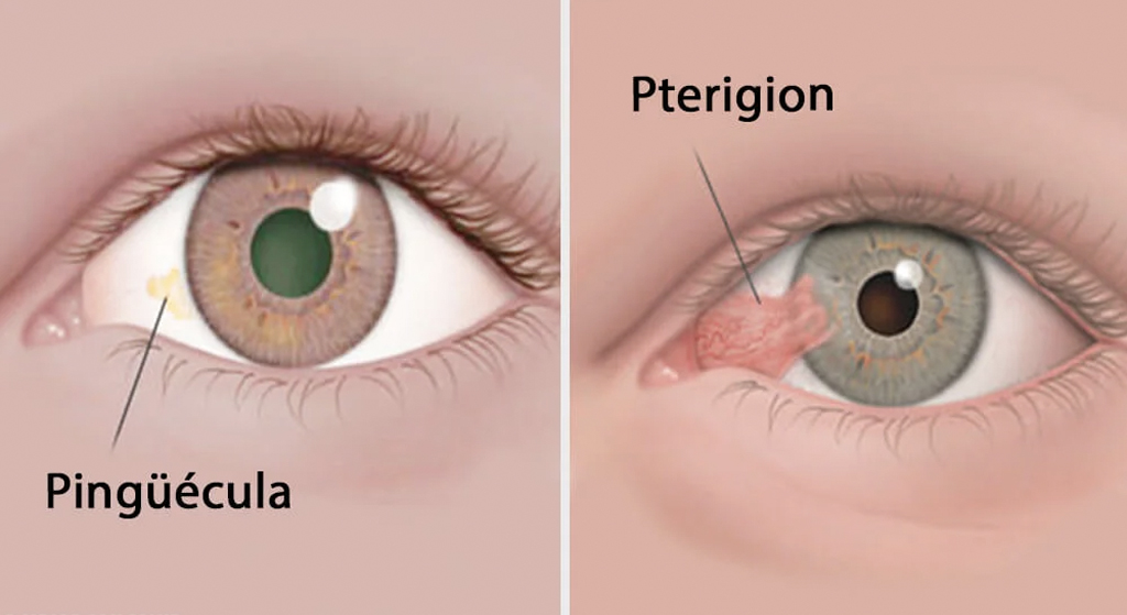 Gotas oftalmológicas - American Academy of Ophthalmology