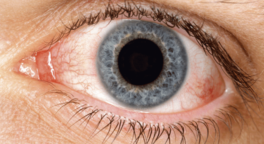 Gotas oftalmológicas - American Academy of Ophthalmology